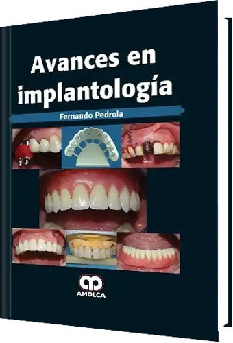 Avances En Implantología