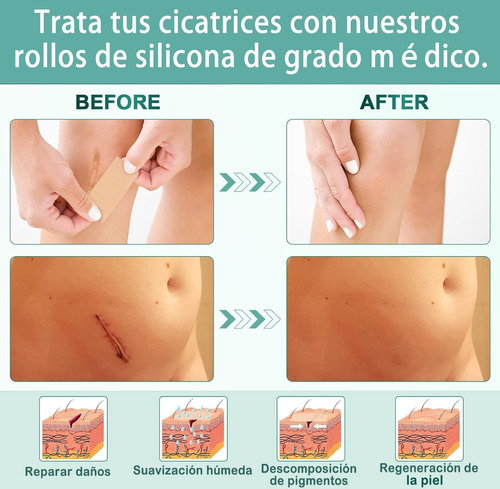 Parches De Silicona Para Cicatricescinta De Silicona
