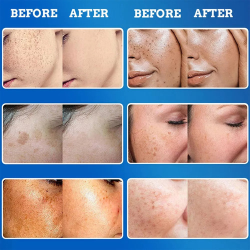 Z Crema Facial Blanqueadora Y Eliminadora De Melanina