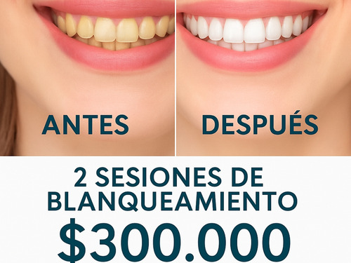 2 Sesiones De Blanqueamiento Dental