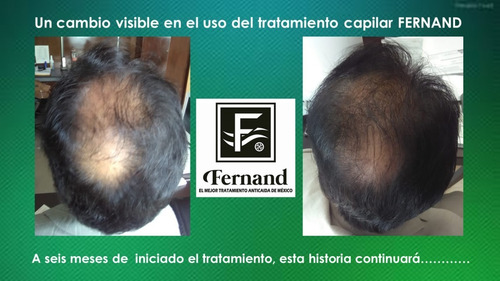 Solución Anticaida Para Hombre Con Cabello Normal