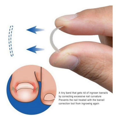 Parches De Corrección De Uñas Pies Encarnadas. Herramienta