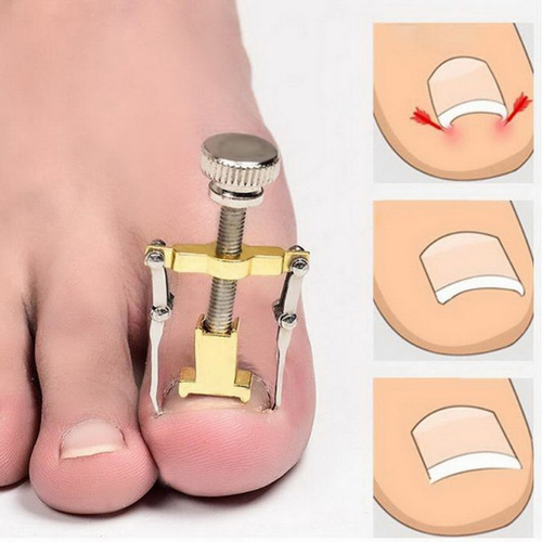 Kit Corrección Uñas Encarnadas Pie Herramienta Pedicura Lima
