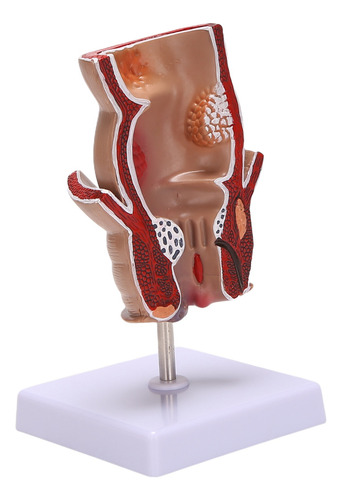 Modelo De Anatomía: Modelo De Lesión De Hemorroides Rectales
