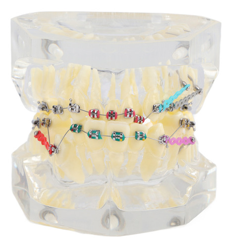 Modelo De Dientes Maloclusión Tratamiento Ortodoncia Dental