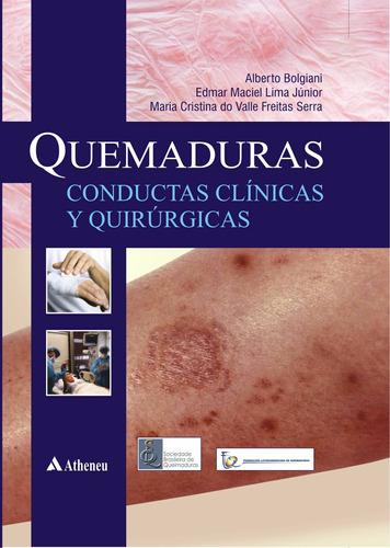 Quemaduras - Conductas clinicas y quirurgicas, de Lima Júnior, Edmar Maciel. Editora Atheneu Ltda, capa dura em español, 2013