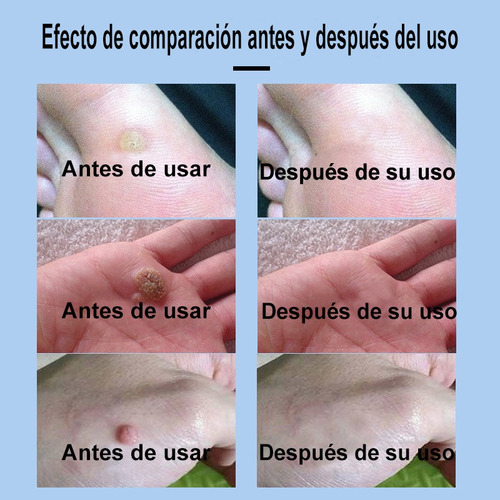 Líquida Para Eliminar Verrugas-eliminación Rápida De Verruga
