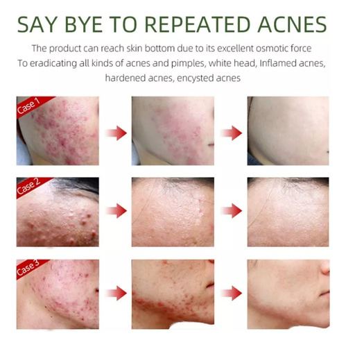 Crema Facial Antiacné, Elimina Profesionalmente Las Marcas