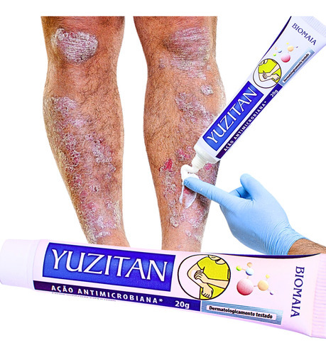 Creme Psoríase Dermatite Alergia Coceira Com Vermelhidão