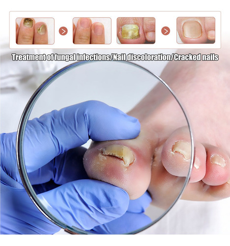 7×reparación La Decoloración Las Uñas Onicomicosis Soft