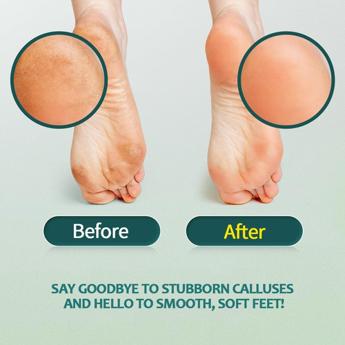 Gorgellux Removedor De Callos Para Pies, Gel Removedor De Ca