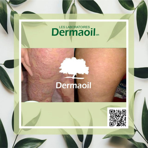 Imagen 5 de 7 de Jabón De Argán Y Caléndula Natural Para Psoriasis