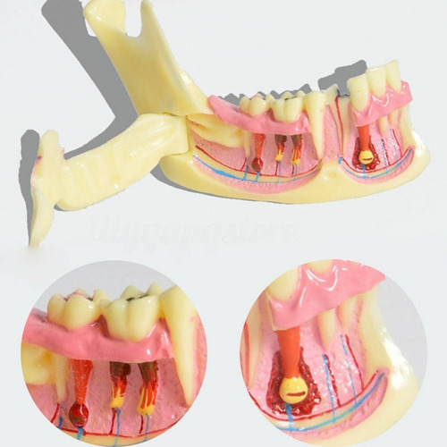 Tipodonto Didactico Lesiones X Cuadrante Iii