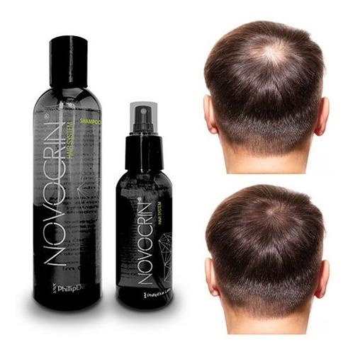 Imagen 1 de 4 de Tratamiento Para La Caída Del Cabello