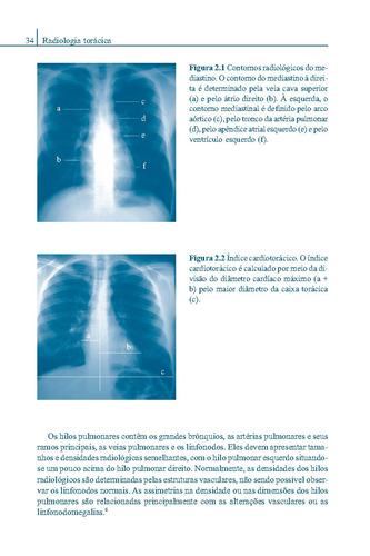 Tromboembolia Pulmonar, de Menna-Barreto, Sérgio S.. Editorial Artmed Editora Ltda., capa dura em português, 2012
