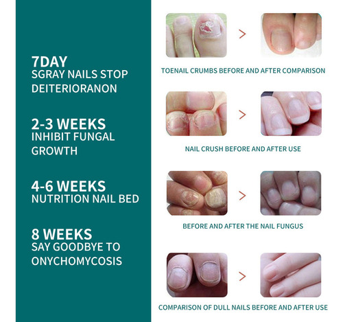 7×reparación La Decoloración Las Uñas Onicomicosis Soft
