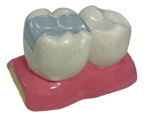 Modelo Dental Resina Y Amalgama