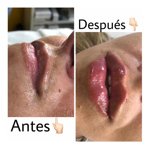 Imagen 5 de 5 de Relleno De Labios