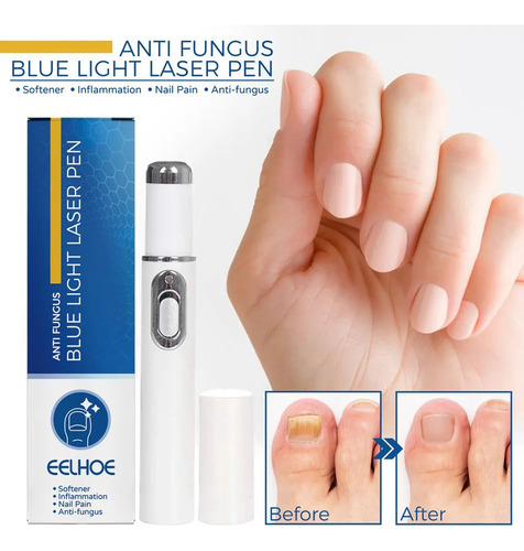 Bolígrafo Láser Hot Nail Fungus Pen Con Luz Azul