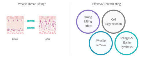 Neogenesis Pdo - Hilos Mono Para Levantamiento Facial Y Corp