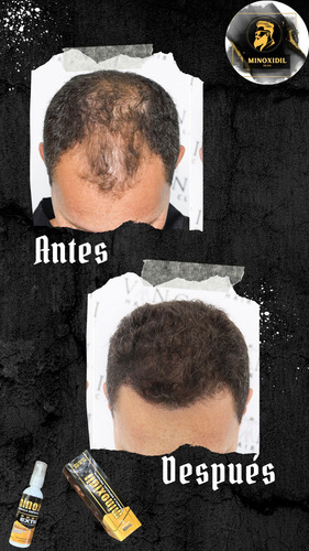 Minoxidil 30.5% Tratamiento Capilar 60ml