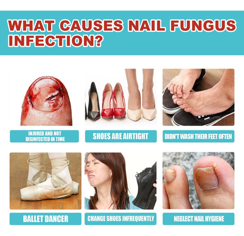 - Tratamiento De Hongos En Las Uñas De Los Pies, 1