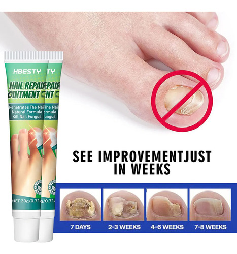 Crema Reparadora De Hongos Para Uñas, Gel Reparador De Uñas,