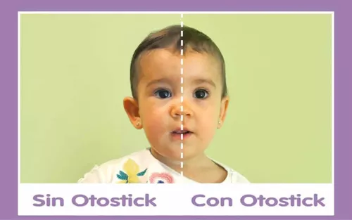 Corrector para orejas separadas Otostick bebé + 1 gorro