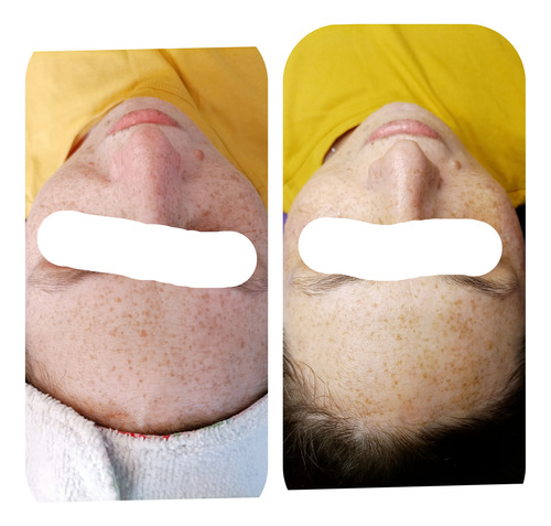 Dermapen Tratamiento Microneedling En Saenz Peña (bs As)