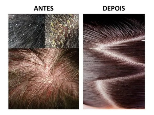 Shampo Cetocasp Cetoconazol Anticaspas Acabe Com As Caspas