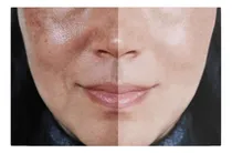 Comprar Crema Aclarante Hidroquinona Acido Kojico Y Retinoico Potent