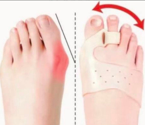 Separador Corrector Hallux Valgus Dedo Del Pie Silicon