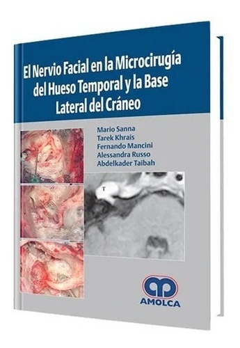 El Nervio Facial En La Microcirugía Del Hueso Temporal Base