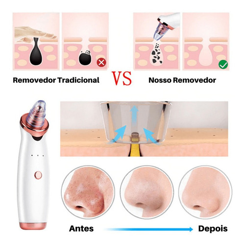 Removedor De Cravos Acne Elétrico Sucção Usb Peeling