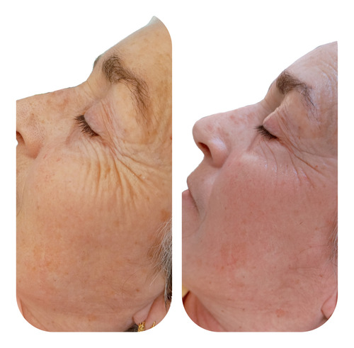 Dermapen Tratamiento Microneedling En Saenz Peña (bs As)