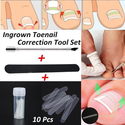 Parches De Corrección De Uñas Pies Encarnadas. Herramienta
