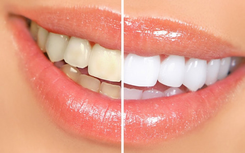 Imagen 2 de 3 de Blanqueamiento Profesional + Limpieza Dental