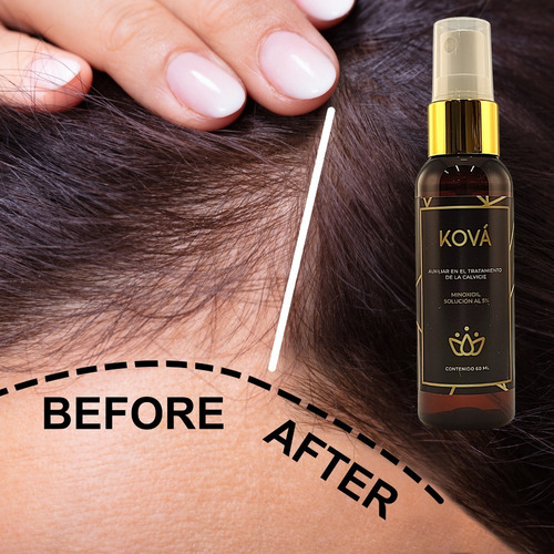 Imagen 2 de 8 de Minoxidil 5% - 3pack Tratamiento Crecimiento Cabello Y Barba