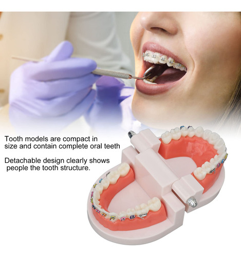 Modelo De Dientes De Ortodoncia Con Soportes De Metal De