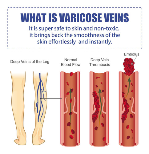 / R Parche Para Venas Varicosas Parche Para Venas Varicosas