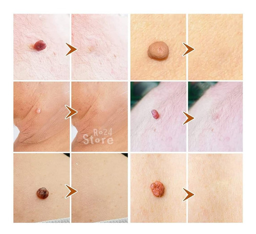 Imagen 5 de 10 de 2 Unid Elimina Verruga Papiloma Lunar Rostro Cuerpo Genital
