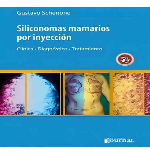 Siliconomas Mamarios Por Inyección Schenone