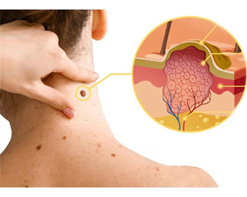 Crema Antipigmentaria Para Eliminar Las Verrugas Del Herpes,