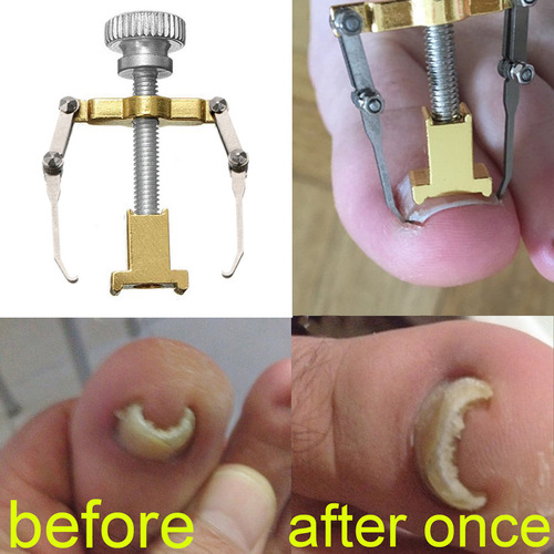 Corrector Profesional De Uñas Encarnadas De Acero Inoxidable
