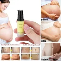 Comprar Estrias Tratamento 3 Tipos De Estrias Estria Branca Na Bunda