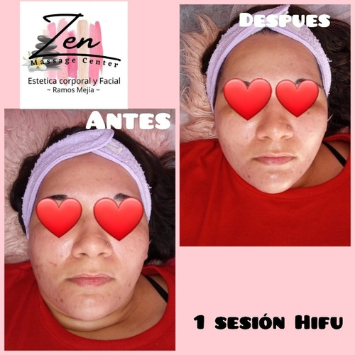 Sesion Hifu 7d Rostro + Cuello + Papada +escote