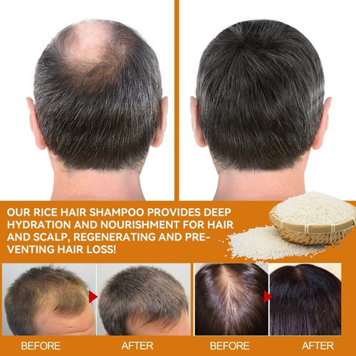 . Shampoo De Crescimento Capilar 200ml Para Queda De Cabelo