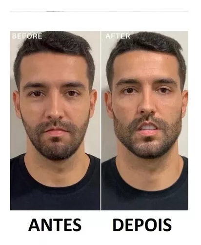 Aparelho Exercício Mandíbula Jawline Definir Maxilar Rosto