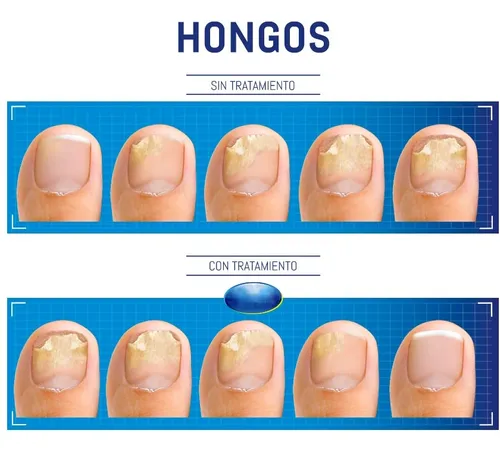 Gotas Hongos Pie De Atletas