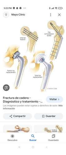 Platinos Quirúrgicos De Cadera 